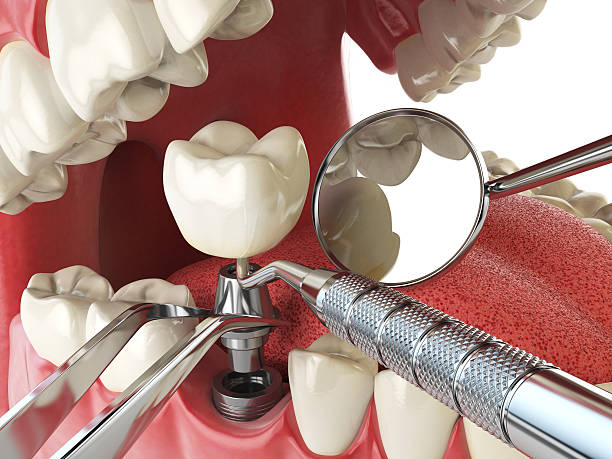 Best Emergency Root Canal Treatment in Riverside, CA